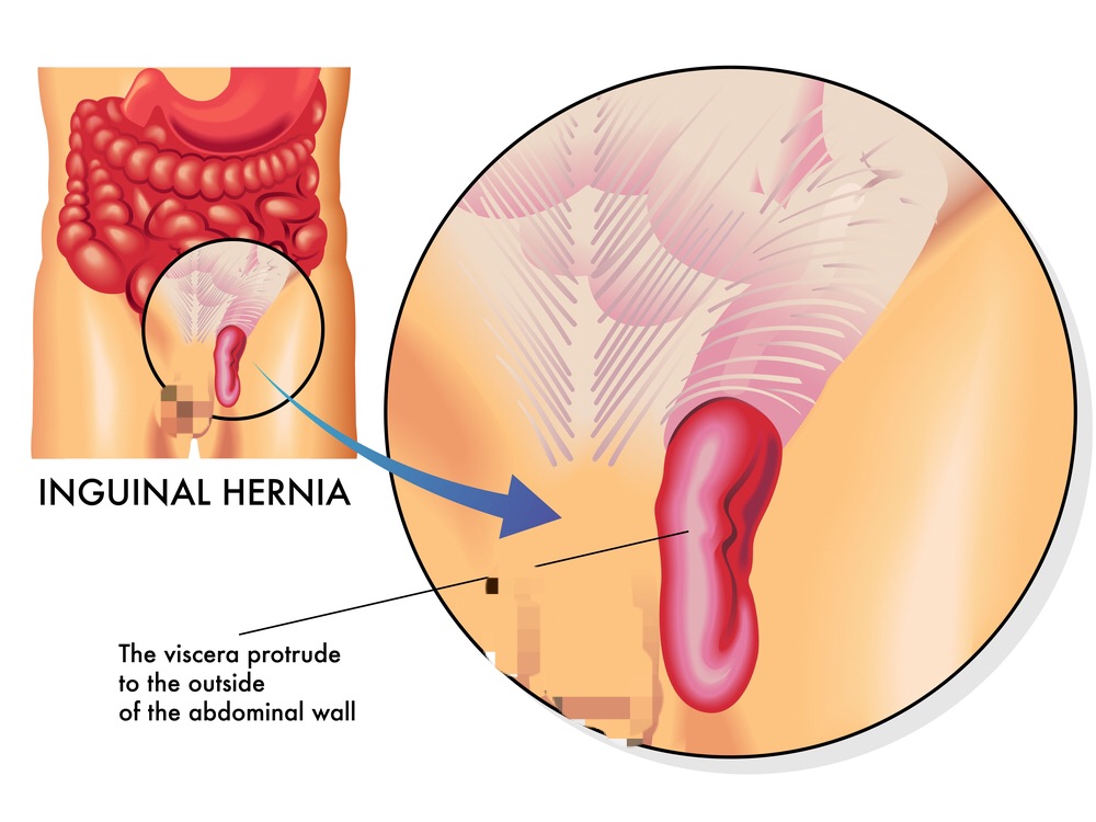 Hérnia Inguinal: aspectos importantes e Cirurgia por Vídeo.