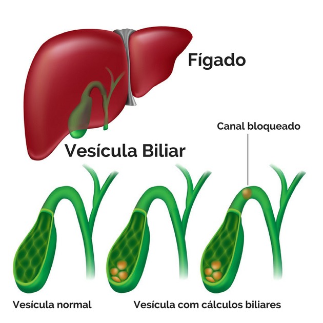 Quanto tempo de repouso é necessário após uma cirurgia de hérnia